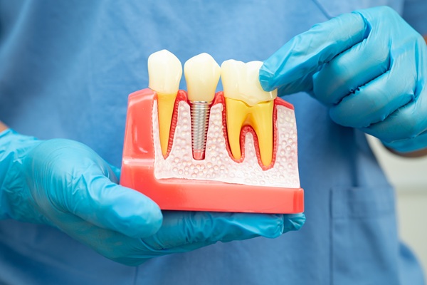 When Dental Implants Are The Ideal Teeth Replacement Option