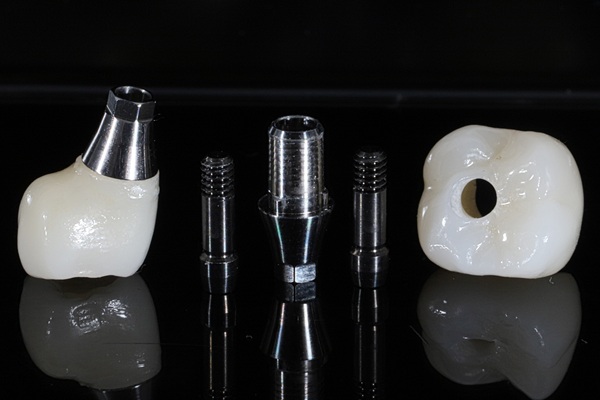 What To Expect After Implant Restoration